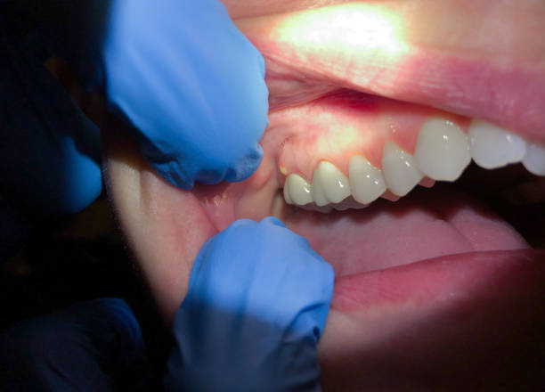 Best Lost Filling or Crown Replacement in Umatilla, OR
